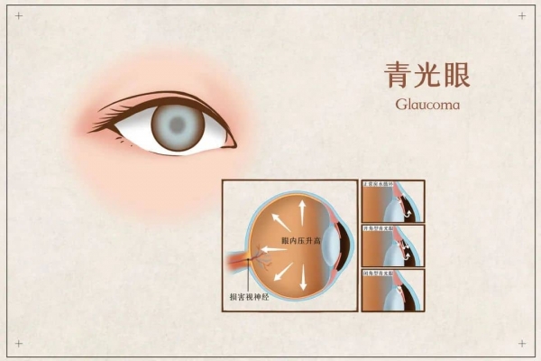 攝圖網(wǎng)_401804072_banner_青光眼醫(yī)療插畫(huà)(企業(yè)商用).jpg 1-tuya.jpg